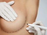 Powiększanie piersi w klinice plastycznej